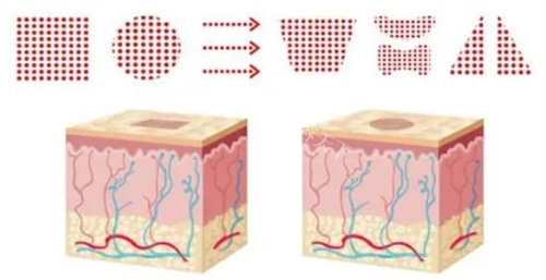 2025点阵激光去痘坑多少钱？1000~5000元不等，根据痘坑类型及治疗疗程价格不等