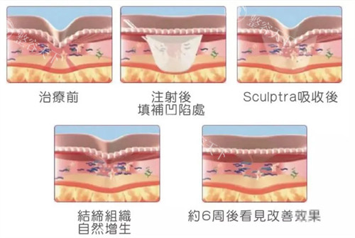 注射童颜针后皮肤的变化周期