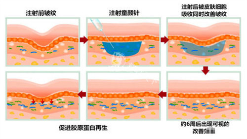 注射童颜针皮肤前后对比图