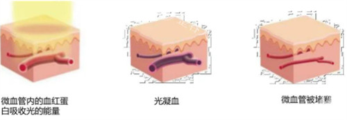 595染料激光治疗过程图解