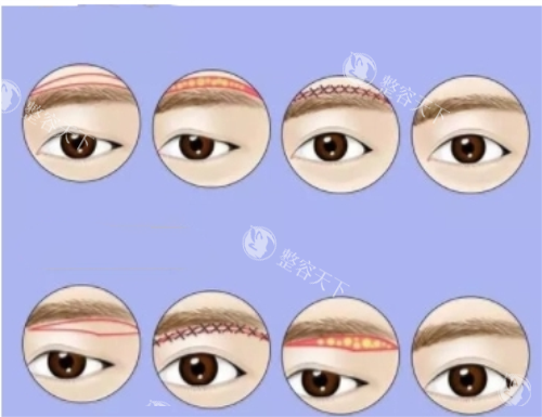 三亚爱丽丝医美提眉术真实反馈！结果到底如何？术前术后对比图全解析！