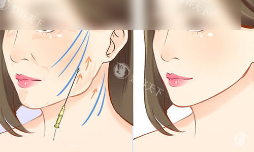 黄寅守面部提升维持多久？V3/V6/V9方案对应时长+整友5年实测