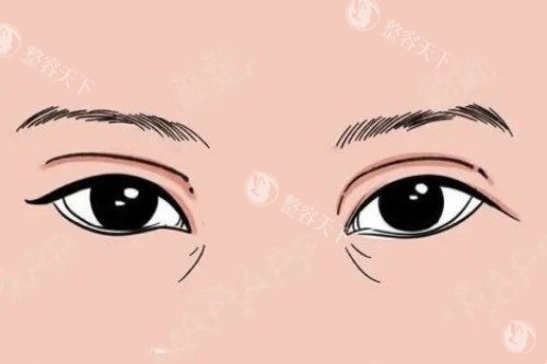魏志香双眼皮修复靠谱吗？真人病例+疤痕隐蔽率92.7%，答案藏在这里