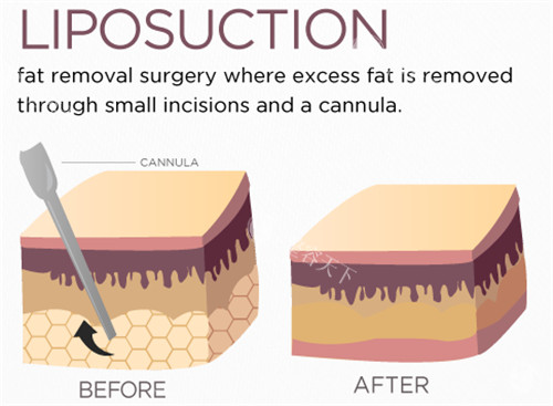 万晓楠医生吸脂技术网友评价太真实！小创口肿胀轻，术后皮肤紧致不松弛性价比拉满