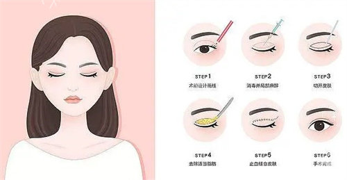 成都双眼皮失败术例深度分析！术后修复要注意什么？过来人经验分享！