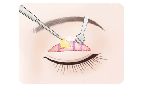 仙桃做双眼皮多少钱？1980元起就能做埋线，全切+开眼角8000起，含术前检查+术后护理，无强制升单