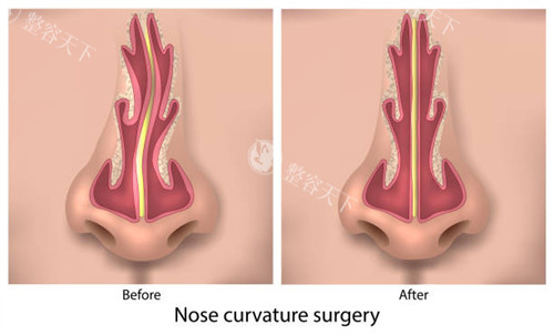 沈阳元辰陈军这位医生做鼻子怎么样？网友真实反馈+术例对比，避雷必看！