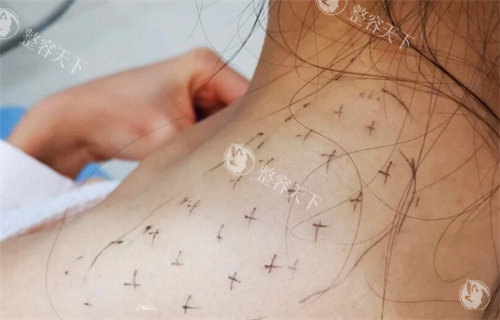 瘦肩注射点位设计图