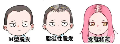 脱发种类