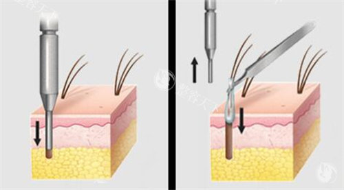 提取毛囊动画演示图图