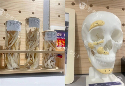 重庆松山医院截骨骨头整理图