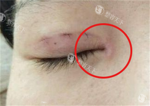 眼角疤痕增生实例图