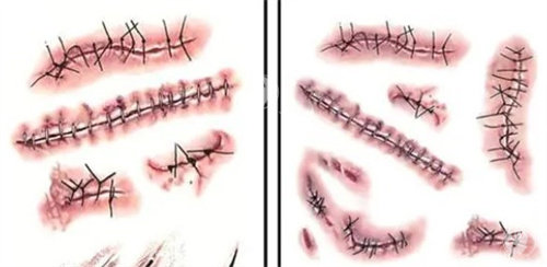 兰大二院祛疤哪个医生好？刘凯/张瑾/张选奋专攻不同疤痕，面诊攻略附联系方式