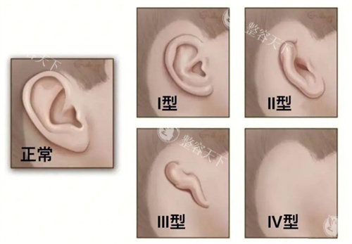 耳畸形的种类