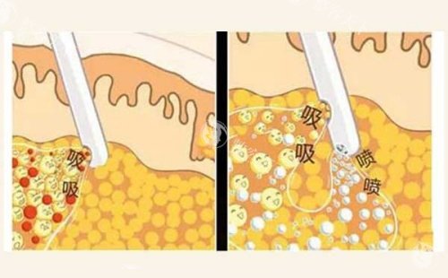 吸脂操作示意图