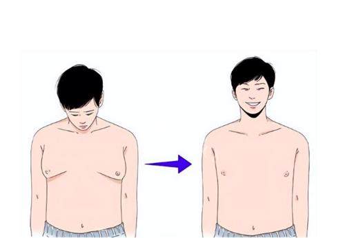男性乳房肥大下垂图