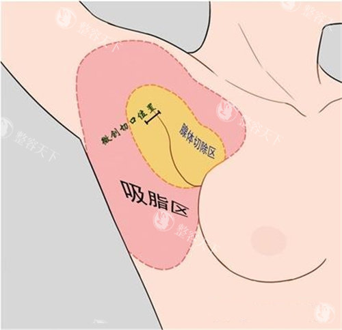 副乳切口位置与吸脂区动画演示图