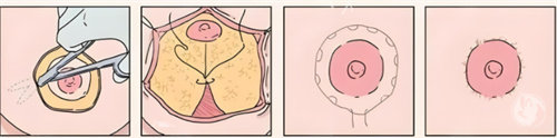 双环切口缩乳术