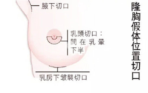 乳房下皱襞切口图