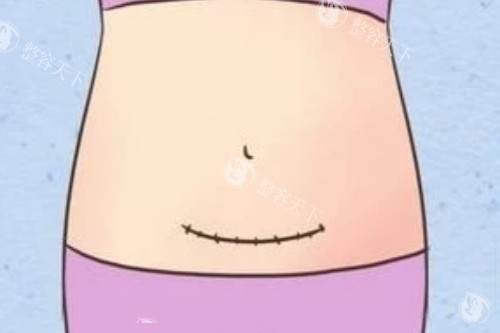 剖腹产疤痕图