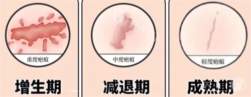 开眼角术后疤痕期