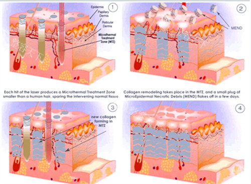 苏州疤痕修复术多少钱？浅表性疤痕2000元起、增生性疤痕2600元起、瘢痕疙瘩12000元起~