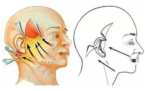高亚东拉皮属于什么档次？明确为高端档次，SMAS筋膜层处理+切口隐蔽，成效持久