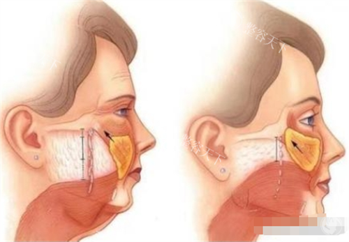 李晓东面部提升靠谱！临床经验足+术式成熟，提拉成效自然，患者反馈良好