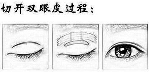 成都刘辅容高难度眼修复多少钱？疤痕粘连/眼窝凹陷修复价分享