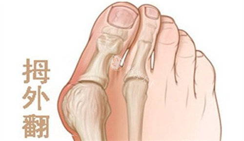 拇外翻