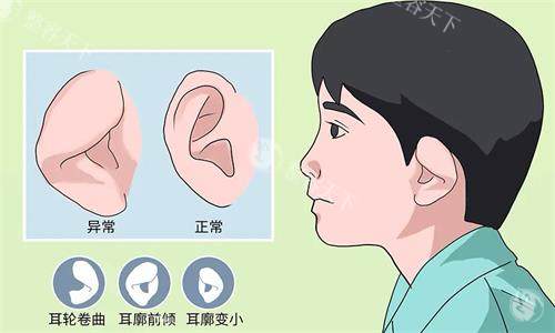耳朵整形示意图
