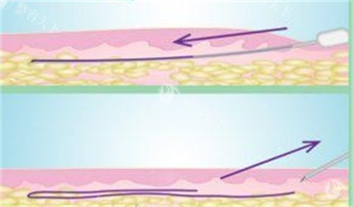 蛋白线深入皮肤展示图