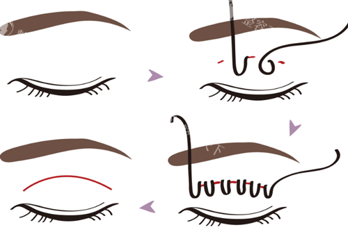 埋线双眼皮手术步骤图
