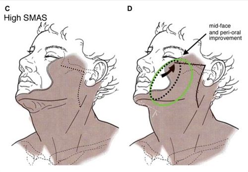 肖海涛医生无痕筋膜提升，3 - 8 年持久抗衰，让你轻松告别面部松弛！