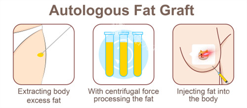 自体脂肪隆胸手术过程