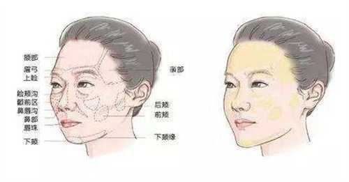 手部注射胶原蛋白有用吗？“填充+再生”双重机制解决手部容积缺失与肤质粗糙问题，附价格参考！