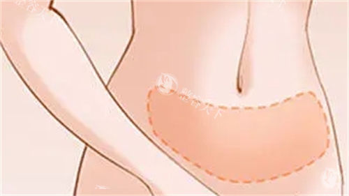 腹部吸脂成效展示图