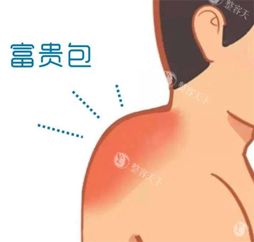 富贵包在身体的位置