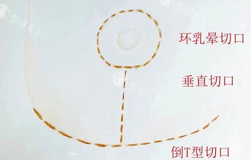 丰胸手术胸部下垂提升倒T字法