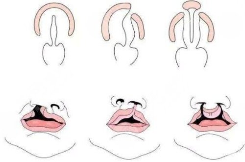 李精韬唇裂修复技术口碑双认证：华 西SF术式+0.1毫米精度，行业公认靠谱