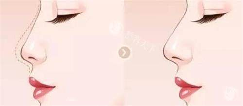 武汉星薇莱徐乃杰医生超擅长做鼻子！定制化设计显立体，术后自然不夸张