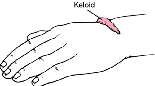 广州疤痕修复正规医院哪家好？广州曙光、美莱、华美的资质/医生/价格全透明，疑难疤痕也能放心治