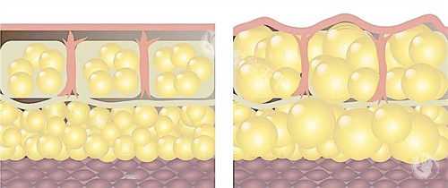 自体脂肪填充前后皮肤层动画图