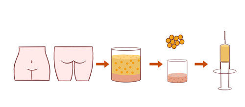 脸部脂肪填充图