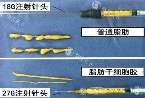 自体脂肪填充需要的脂肪提纯后的样子图片