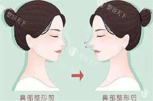 亲述！我找王旭东做完隆鼻手术，从塌鼻丑女到精致女神的逆袭历程！