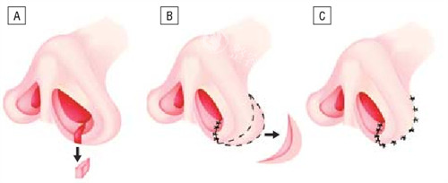 鼻孔大小不一样