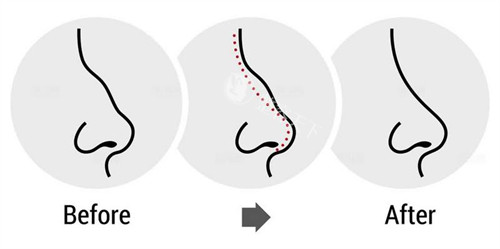 驼峰鼻子的改变过程图