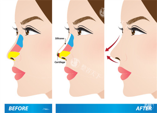 矫正朝天鼻流程图
