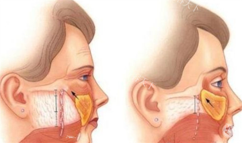 成都何先富医生核心优势：拉皮技术+临床经验详解